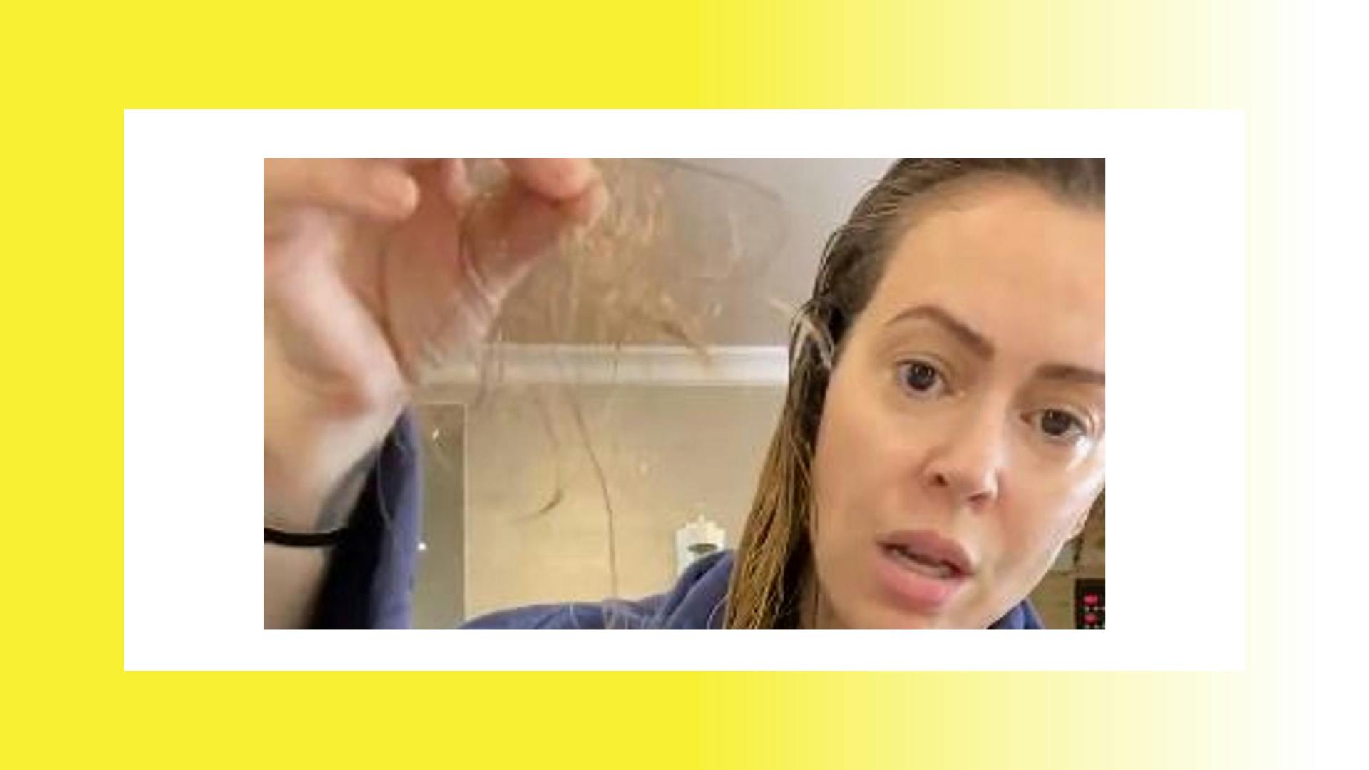 Dermatologists Are Claiming Hair Loss Is The New Symptom Of COVID19